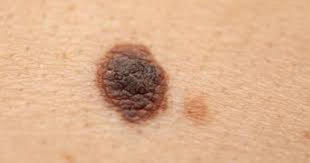 Capire il melanoma dalla diversificazione cellulare - 