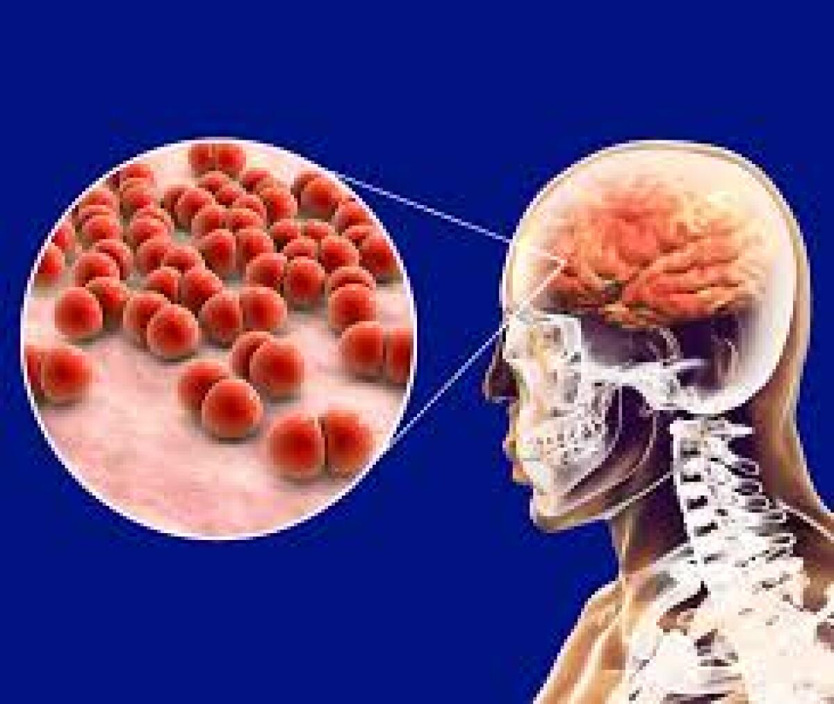 Vaccino contro il meningococco B, causa di meningite - 