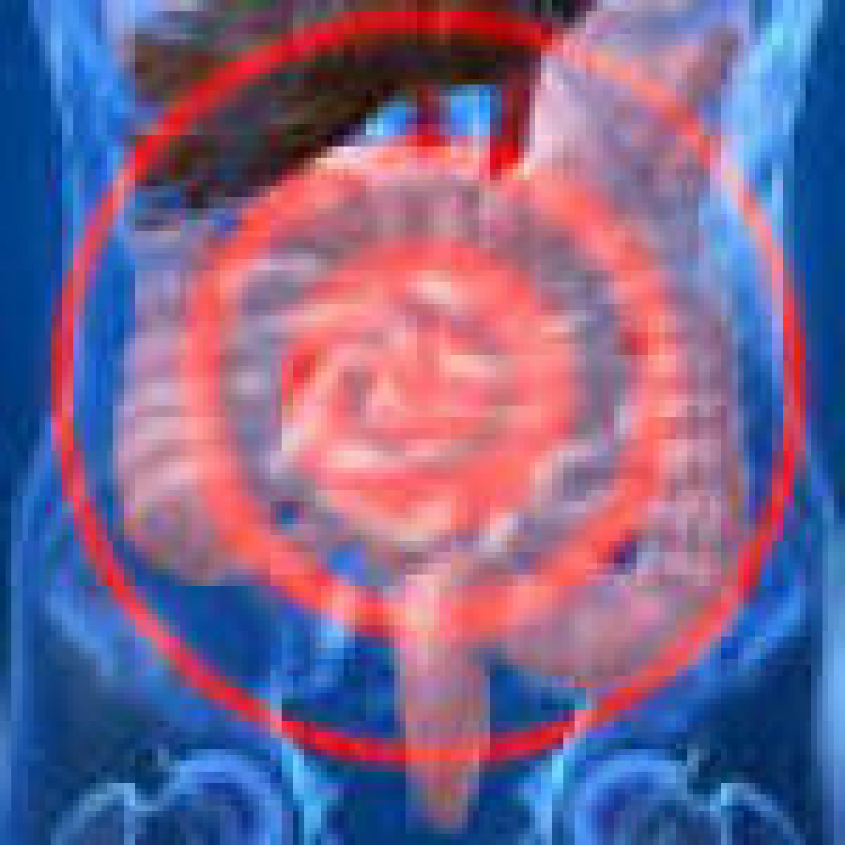 Tumore del colon retto: scoperto un gene ‘mordi e fuggi’ - 