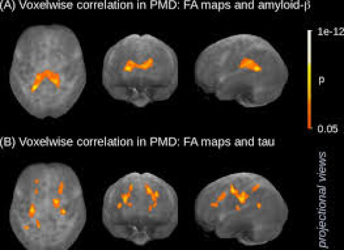 Nuova terapia contro la malattia di Phelan McDermid - 