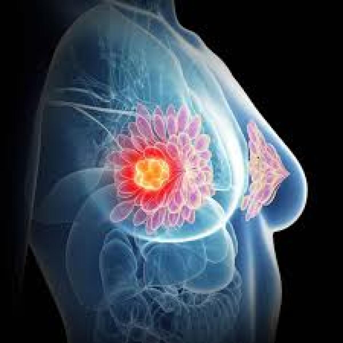 Un passo avanti contro il cancro al seno - 