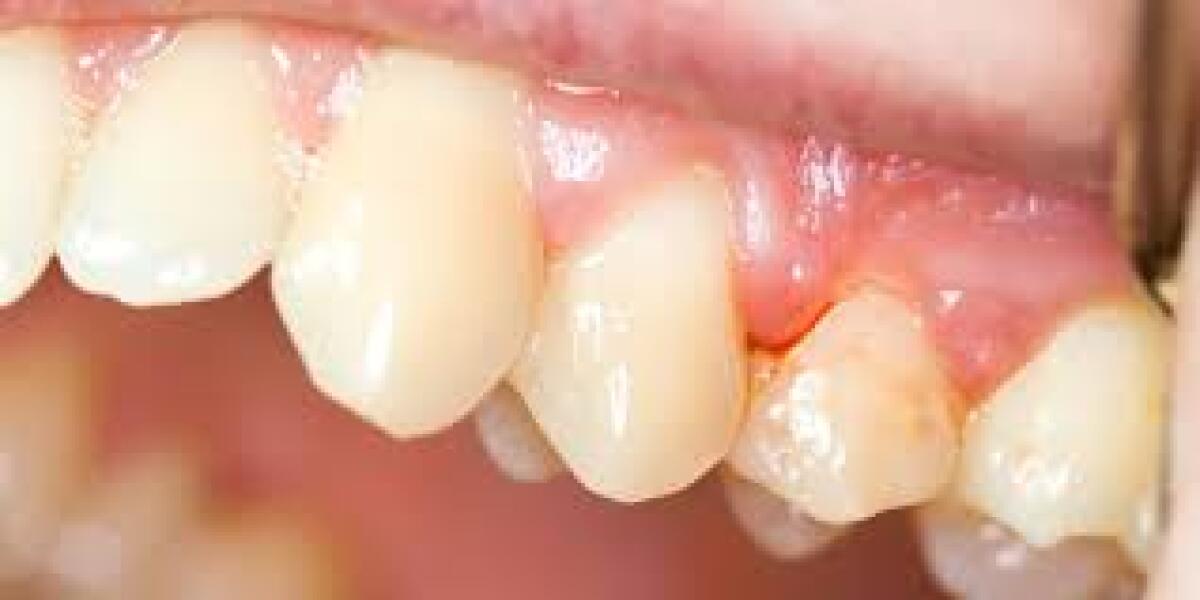 Le cause del sanguinamento gengivale e i rimedi - 