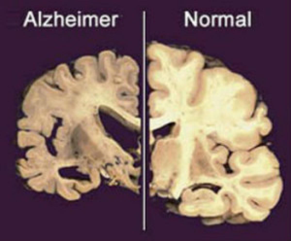 Alzheimer, scoperta molecola che “ringiovanisce” cervello dei topi e può bloccare la malattia - 