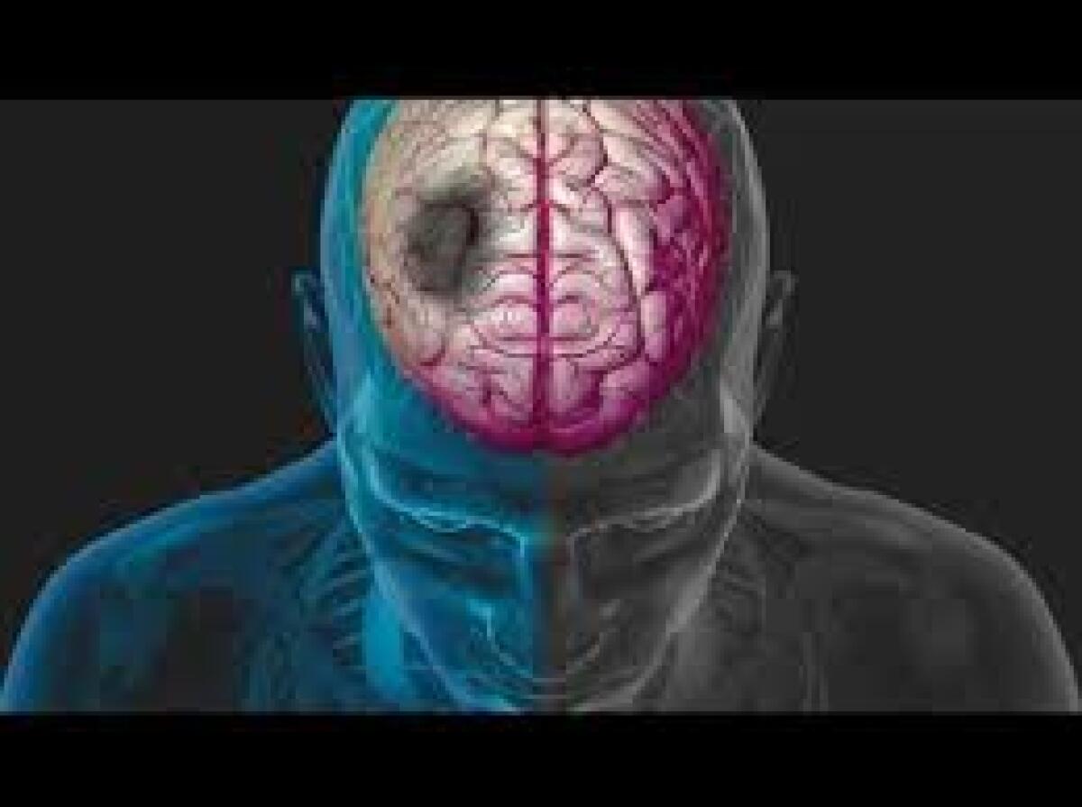 Lampo di luce infrarossa per studiare gli astrociti e l’edema cerebrale - 