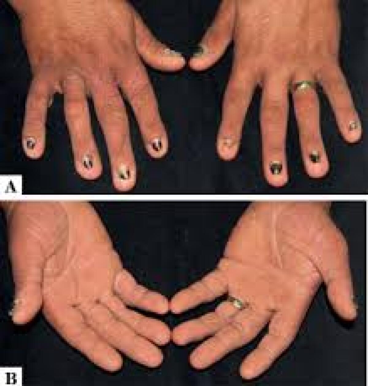 Un anticorpo monoclonale per contrastare la sindrome di Clouston - 