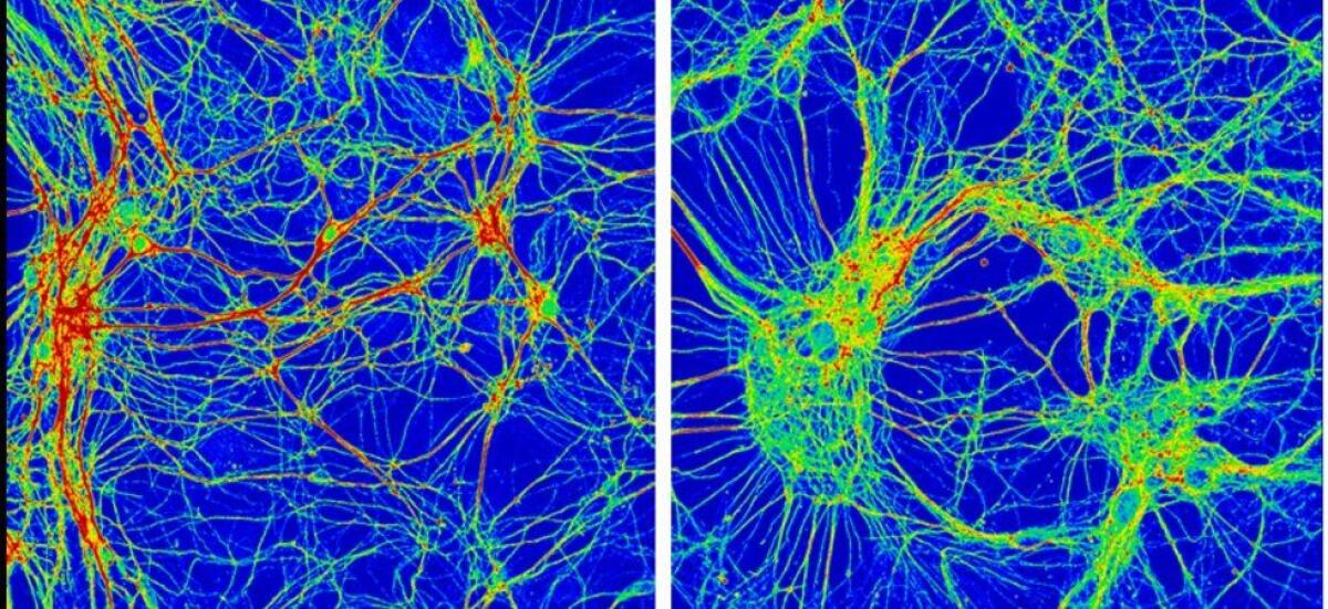Identificati i difetti molecolari di due patologie neurologiche - 