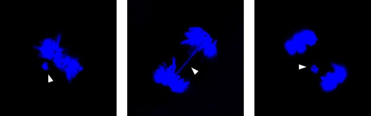 Identificata proteina responsabile dell’instabilità genomica nell’osteosarcoma - 