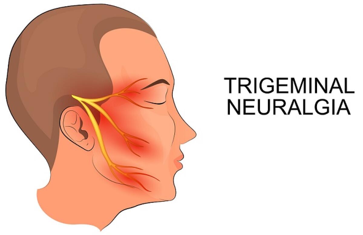 Nevralgia del Trigemino - 