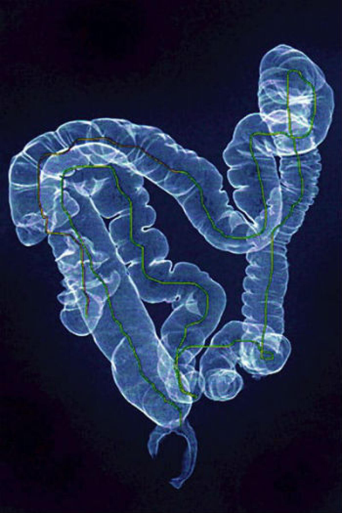 Asp Enna. Marzo: mese della prevenzione del tumore al colon-retto - 