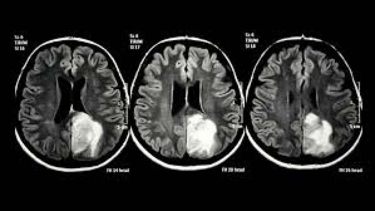 Nuovo anticorpo rallenta progressione glioblastoma e riduce iperattività cerebrale indotta dal tumore - 