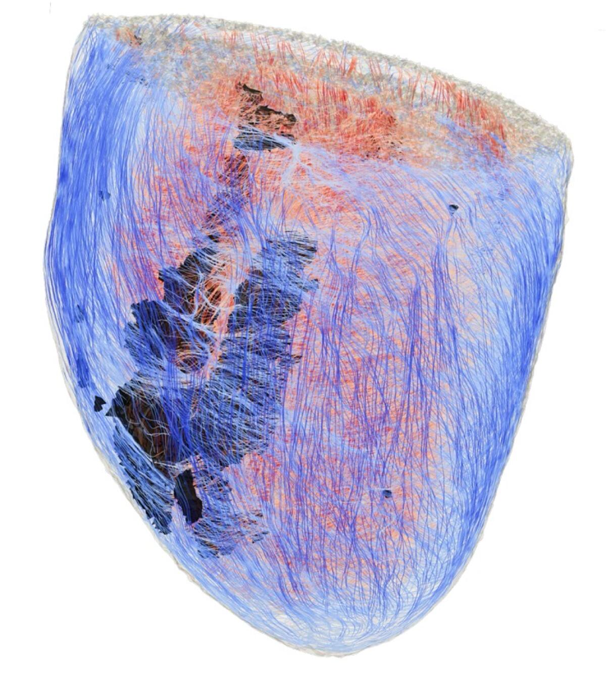 Svelato come la fibrosi cardiaca favorisce le aritmie - 