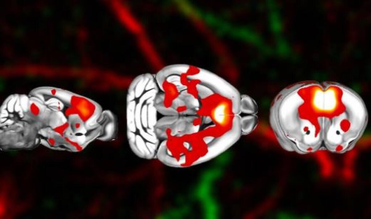 Dalla terapia genica la prospettiva per contrastare una malattia cerebrale - 