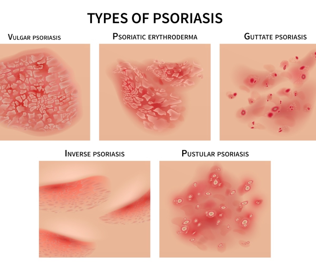 Psoriasi: ecco come si amplifica l’infiammazione cutanea - 